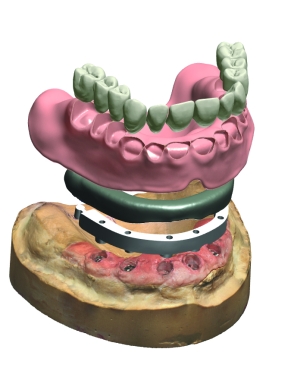 Dental System Complete Restorative